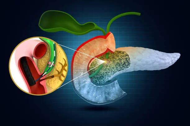 Gallstone Removal: Top Expertise in Kalyan Dr. San...
