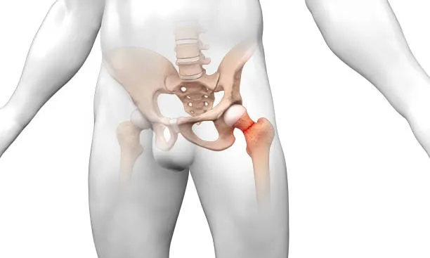 "Hip Replacement Excellence: Dr. Rakesh Gosavi in ...