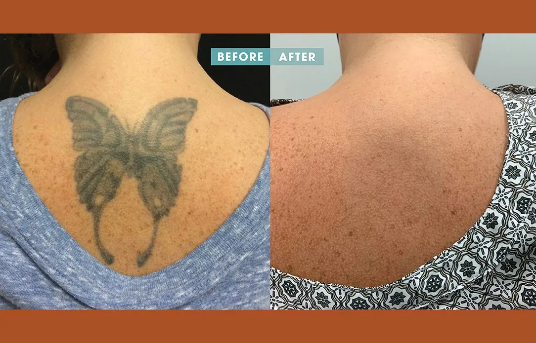 Laser Treatment in Janakpuri
Laser treatment has ...
