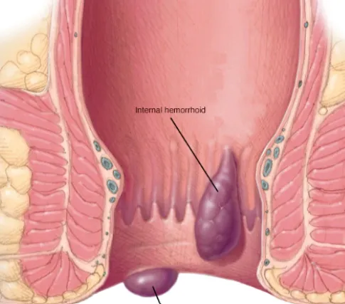 "Beyond Surgery: The Role of Diet in Piles Managem...
