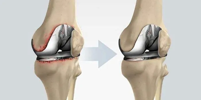 "Hip Replacement Excellence: Dr. Rakesh Gosavi in ...