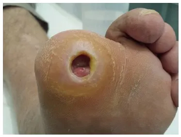 How Diabetes Affects Wound Healing: Normal Healing...