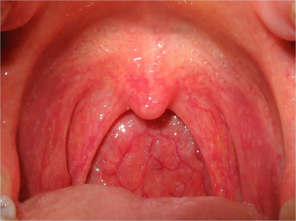 Understanding and Dealing with Pharyngitis:(Sore T...