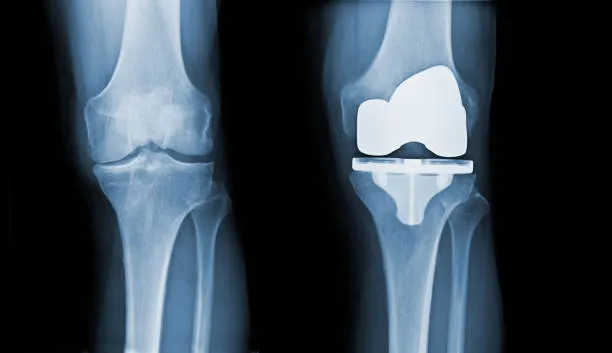 Navigating Knee Replacement in Nashik: Dr. Rakesh ...