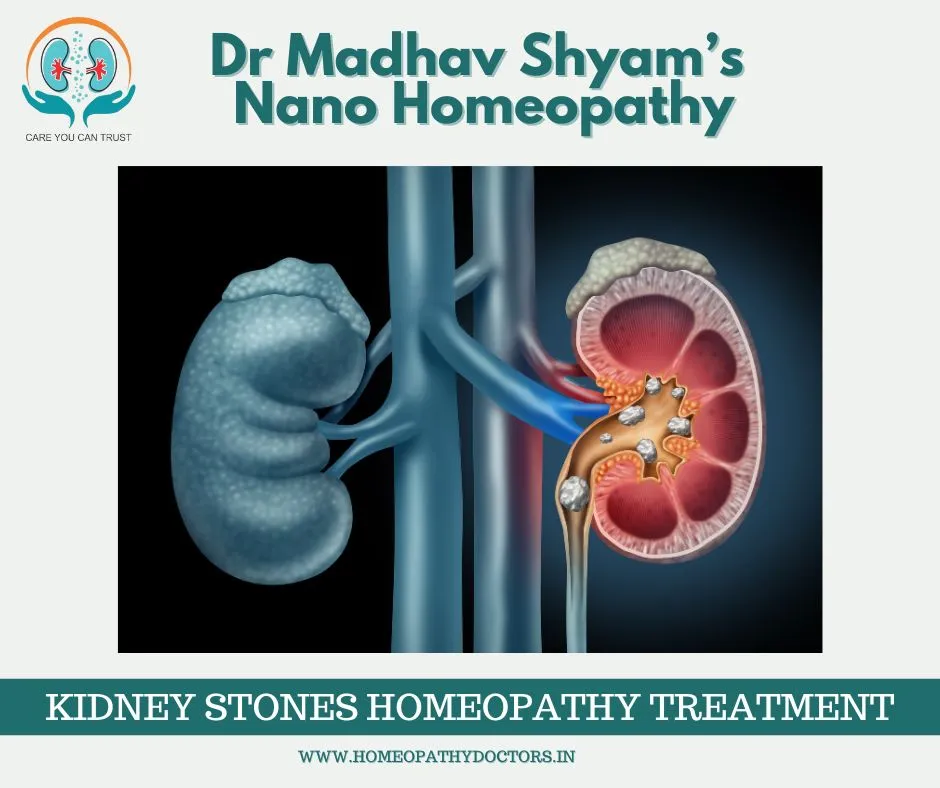 A kidney stone is a hard object that is made from ...