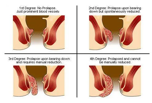 What is an internal pile?
Internal hemorrhoids li...