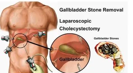 Best Laparascopic Gastrosurgeon in Thane dealing w...