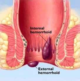 Recent Advances in Piles Treatment at Dr. Phapale ...