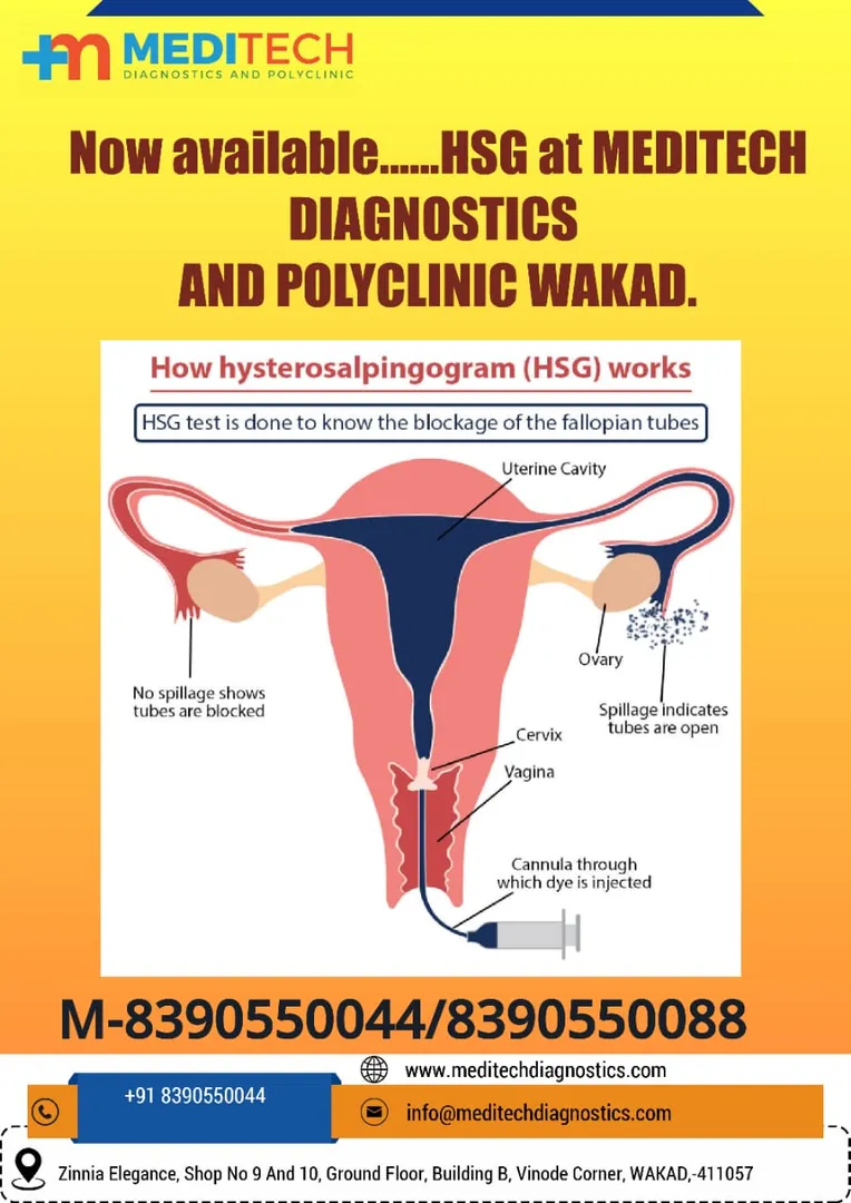 Hysterosalpingography (HSG), also known as uterosa...