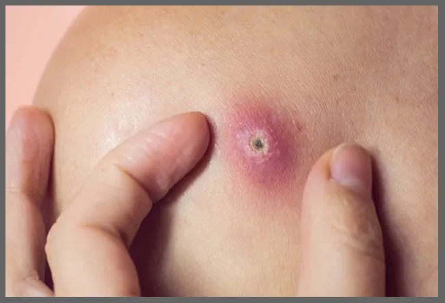 Recurrent Boils on the Body: Causes, Signs, Sympto...