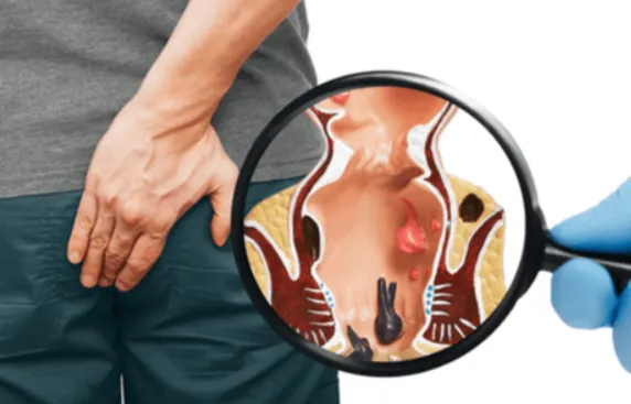 Best Piles Doctor in Pune: Comprehensive Care at D...