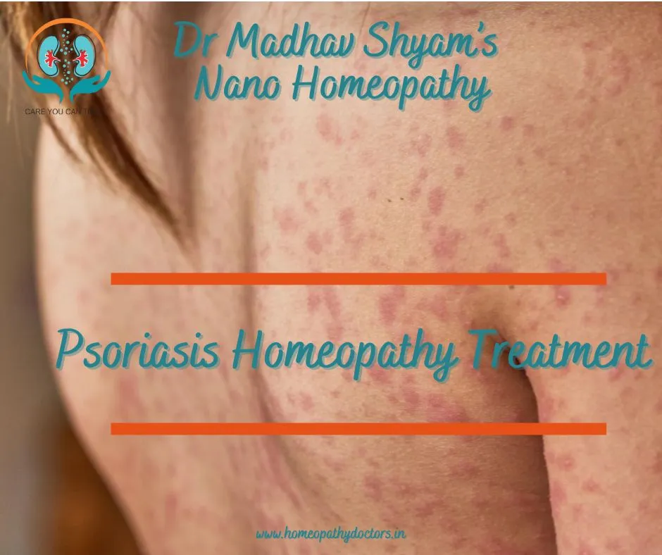 Homeopathic Remedies for Psoriasis
Psoriasis is a ...