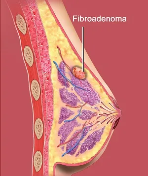 Breast Fibroadenoma A fibroadenoma is a common, no...