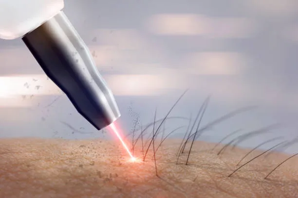 Silky Smooth: Laser Hair Removal Solutions in Pune...