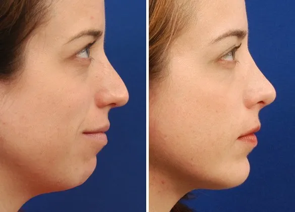 Chin Augmentation in West Delhi
Chin augmentation...