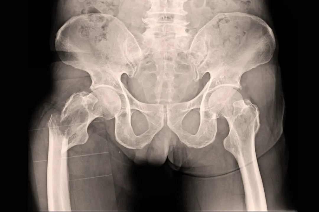 Open Reduction with Internal Fixation (ORIF) Surge...