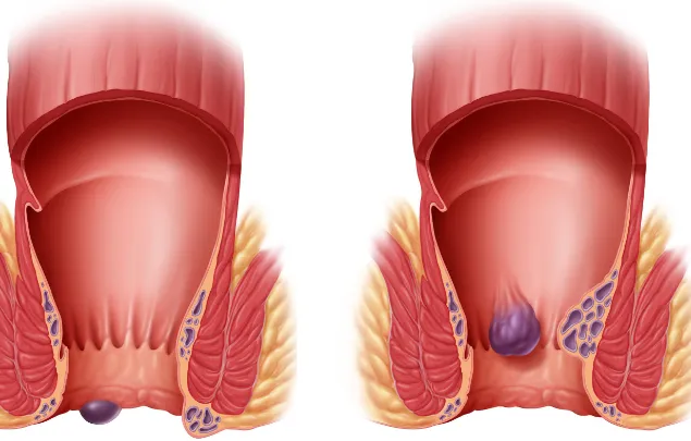 Advances in Piles and Fissure Treatment: A Glimpse...