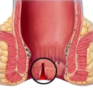 Fissure Treatment Excellence at Dr. Phapale Hospit...