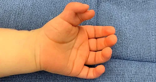 Understanding Polydactyly: Types and Surgical Opti...