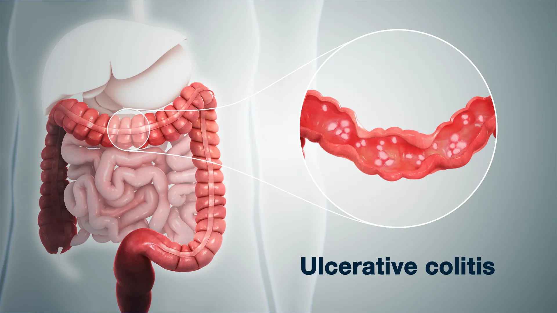 Understanding Ulcerative Colitis Inflammatory bowe...