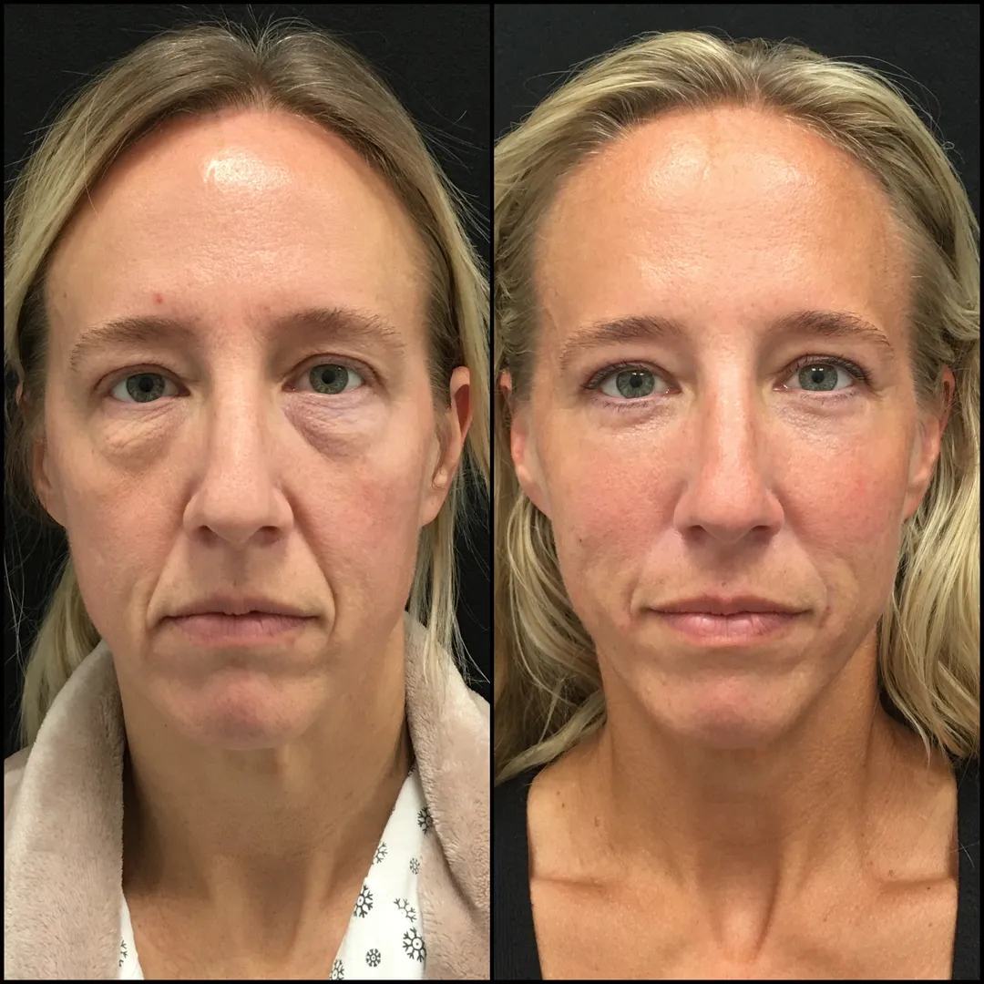 Blepharoplasty in West Delhi
The eyes are often c...
