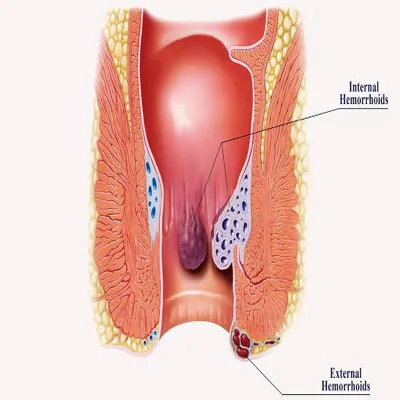 Internal hemorrhoids
You usually can't see or feel...
