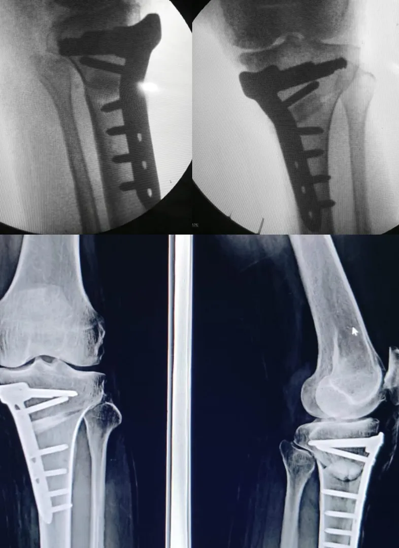 two different patients treated with knee preservat...