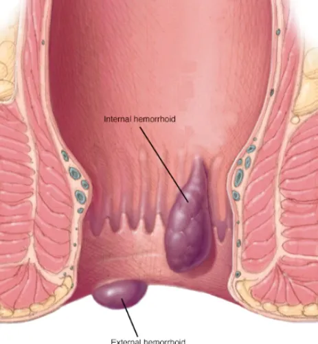 Injection Therapies for Piles and Fissures Precisi...