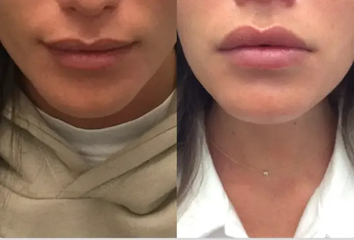 Lip Flip Surgery in West Delhi
Discover the artis...