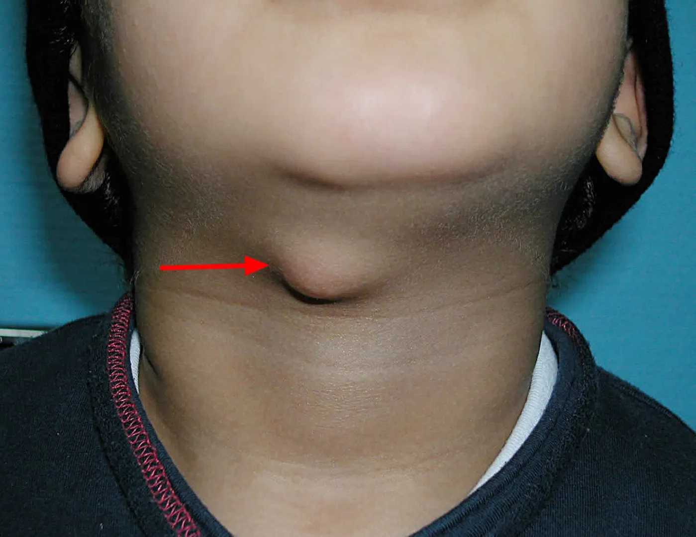 Thyroglossal Duct Cysts (TDC): Definition: Thyrogl...