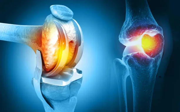 Orthopedic Excellence with Dr. Rakesh Gosavi – You...