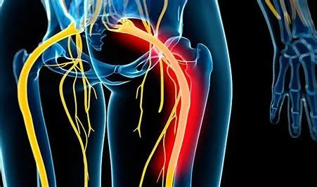Causes of Sciatica
Sciatica is a common condition...