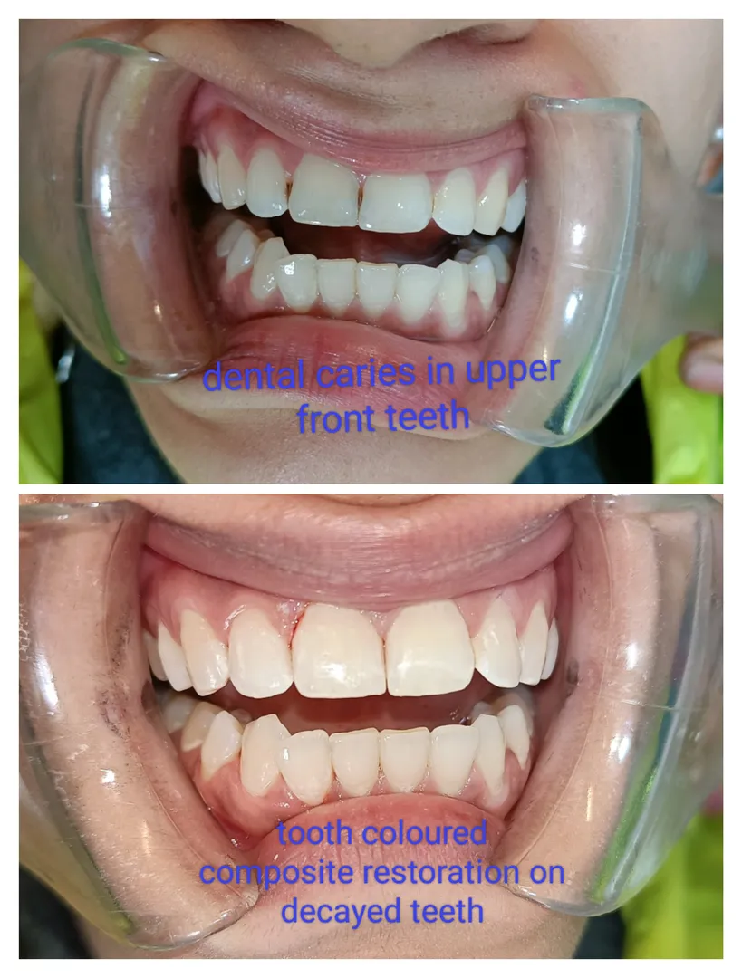 #compositerestoration
#aestheticfilling
#toothcolo...