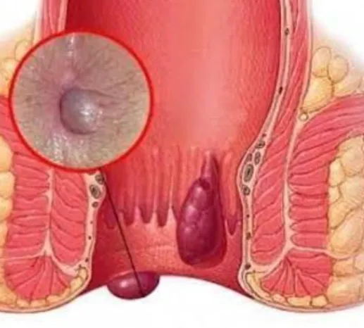 Fissure Treatment at Dr. Phapale Hospital Best Fis...