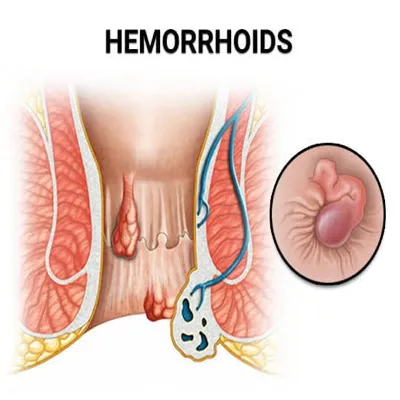 Strangulated piles (strangulated hemorrhoids), is ...