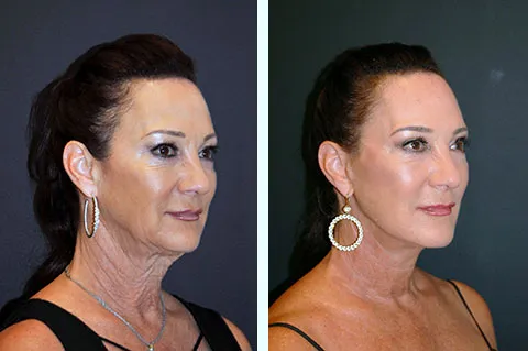 Face Lift in West Delhi
For those seeking a less ...