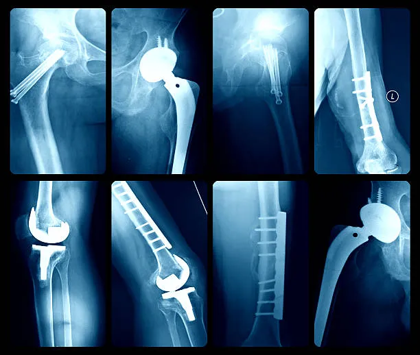 A Comprehensive Guide to Knee and Hip Replacement ...