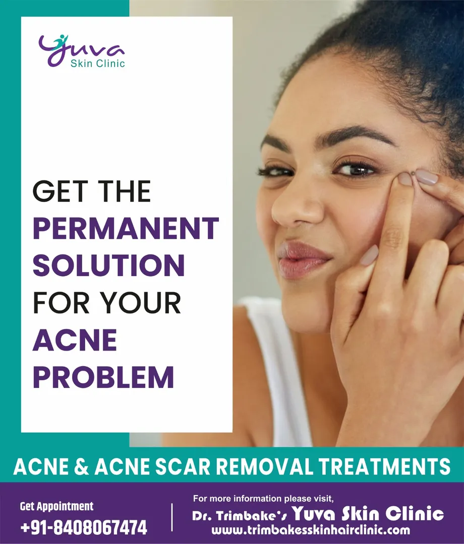 Dont pop your Acne (pimples)...
Bacteria from you...