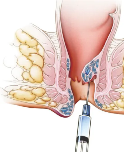 Comprehensive Injection Treatment for Piles and Fi...