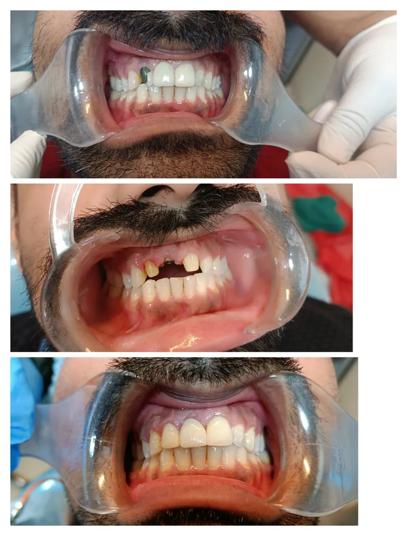#zirconiacrowns
#implantdentistry
#drnavratnasingh...