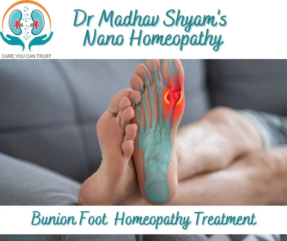 A bunion, medically known as hallux valgus, is a b...