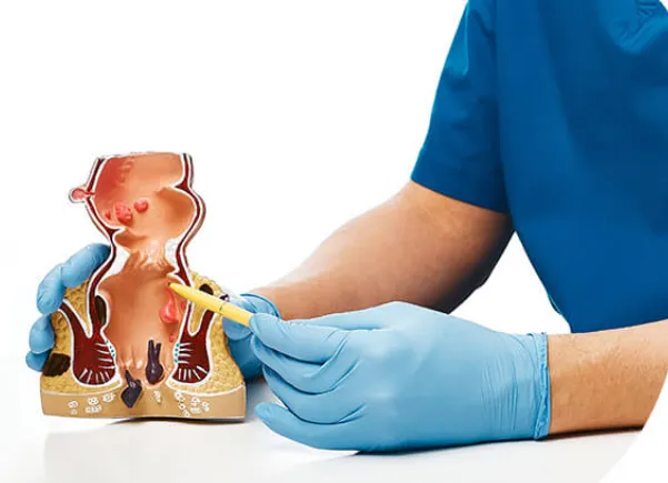 Fissure Demystified: Symptoms, Treatment, and Prev...
