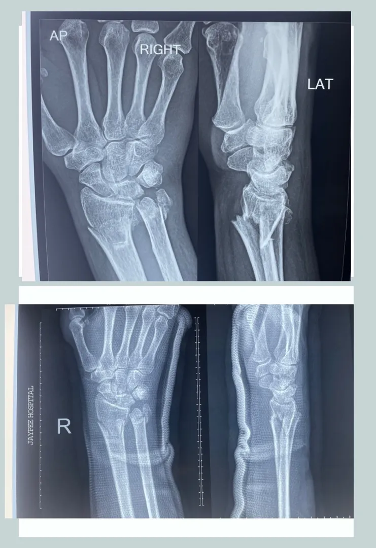 #Conservative treatment for fracture wrist A 55 ye...