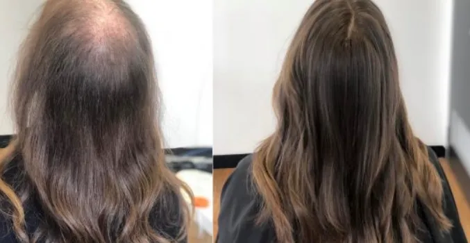 Prevent Hair Fall with Expert Solutions in Nashik ...