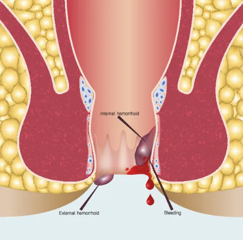 Piles and Fissures: Recent Advances in Treatment O...