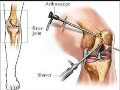 Enhancing Recovery: Arthroscopic Solutions for Men...
