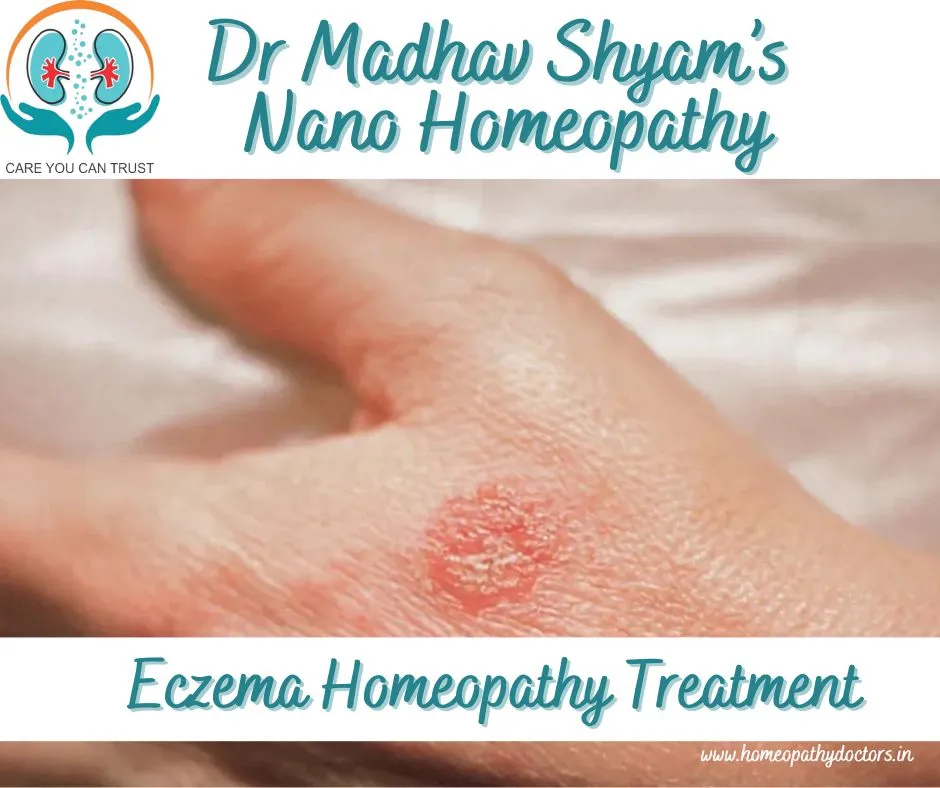 Eczema Homeopathic Treatment
Eczema, also known as...