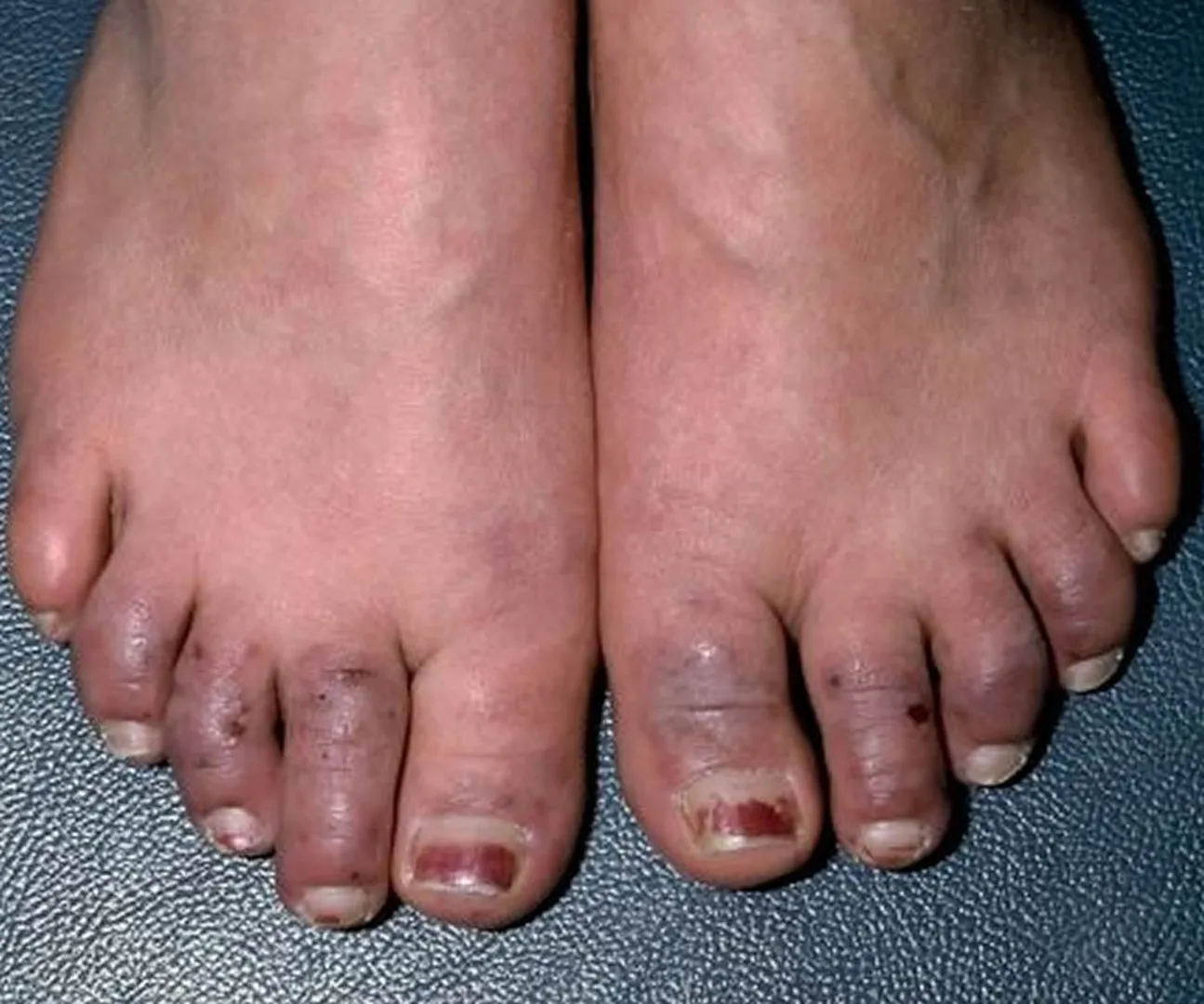 Thromboangiitis Obliterans (TAO): Understanding a ...