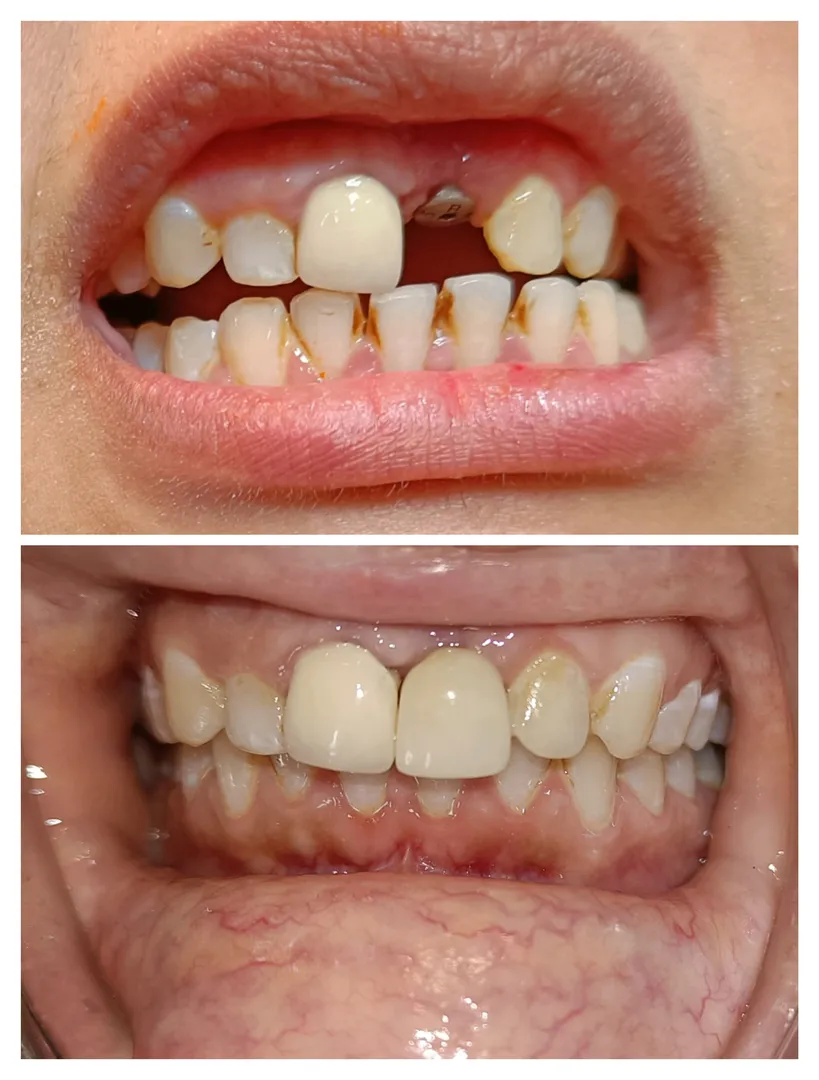 #implantdentistry
#immediateimplant
#implantinaest...