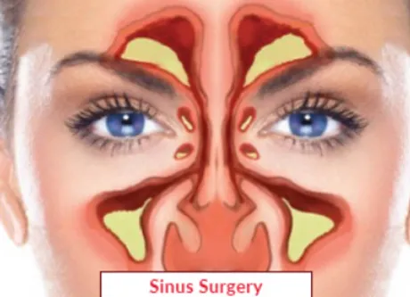 Sinus Surgery Mastery: Dr. Chaitanya C Bharadwaj's...
